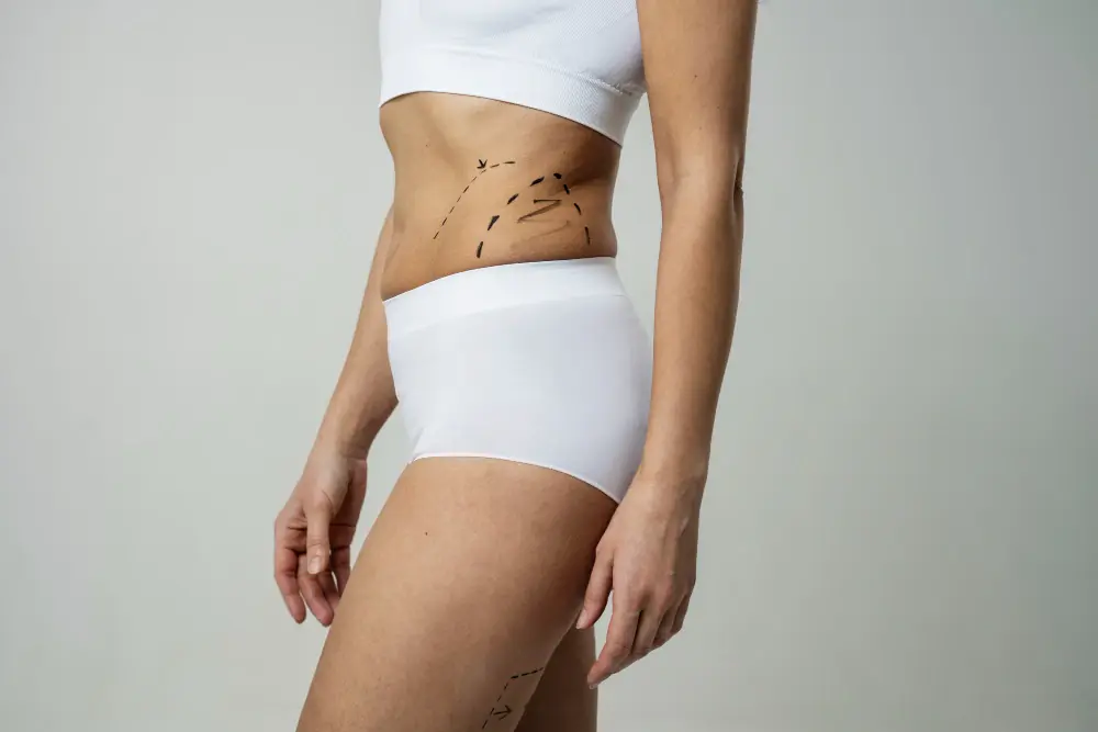 Liposuccion