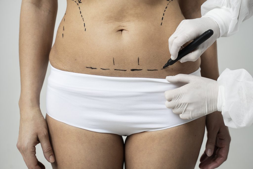 Marcacion Abdominal