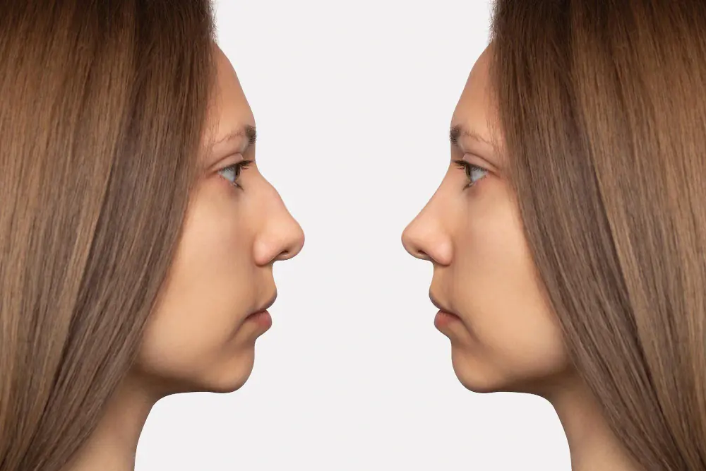 Rinoplastia